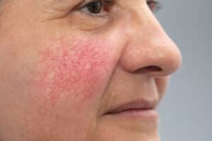 Woman with rosacea flare-up in Chevy Chase, MD